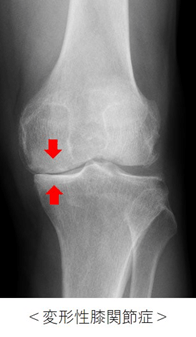 ＜変形性膝関節症＞