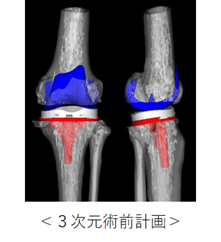 ＜3次元術前計画＞