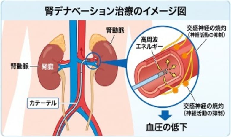 高血圧に対する新たな治療「腎デナベーション治療」の体制を整えました